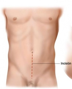incision-abdominal