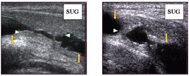 Fig3-Imagen-ecografica-de-estenosis-de-uretra
