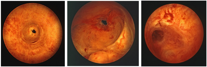 Fig5-Imagenes-endoscopicas-de-estenosis-de-uretra-diagnosticadas-mediante-el-cistoscopio-flexible