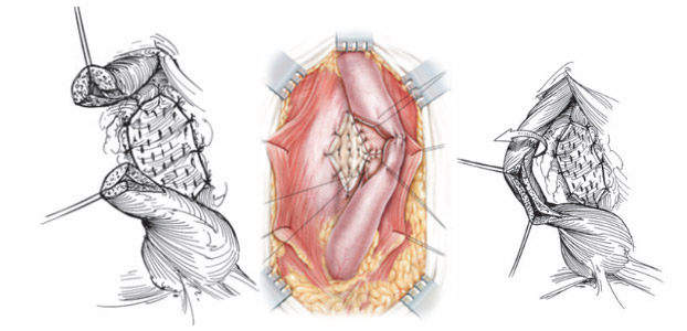 Fig12.-Colocacion-de-injerto-dorsal-apoyado-en-los-cuerpos-cavernosos-en-diferentes-tecnicas-de-uretroplastia