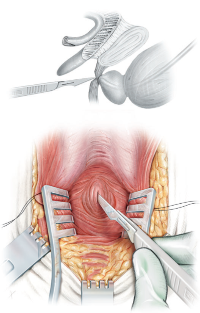 FigA-incision-a-nivel-de-diafragma-urogenital