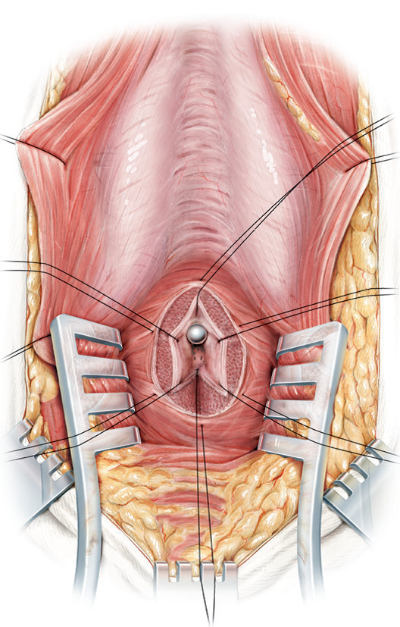 FigB-Puntos-de-sutura-para-posterior-anastomosis