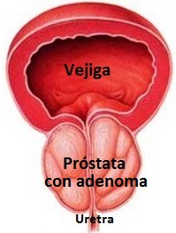 fig2-Prostata-con-adenoma