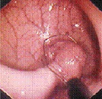 Extracción de un pólipo en el colon