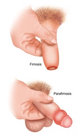 Fimosis-Parafimosis
