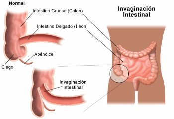 invaginación_intestinal