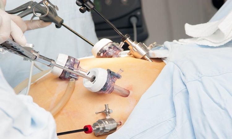 laparoscopia quirúrgica Ginecología Obstetricia cirugía minimamente invasiva