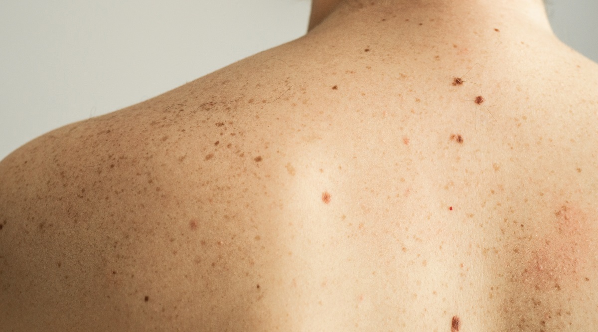 sintomas cancer de piel