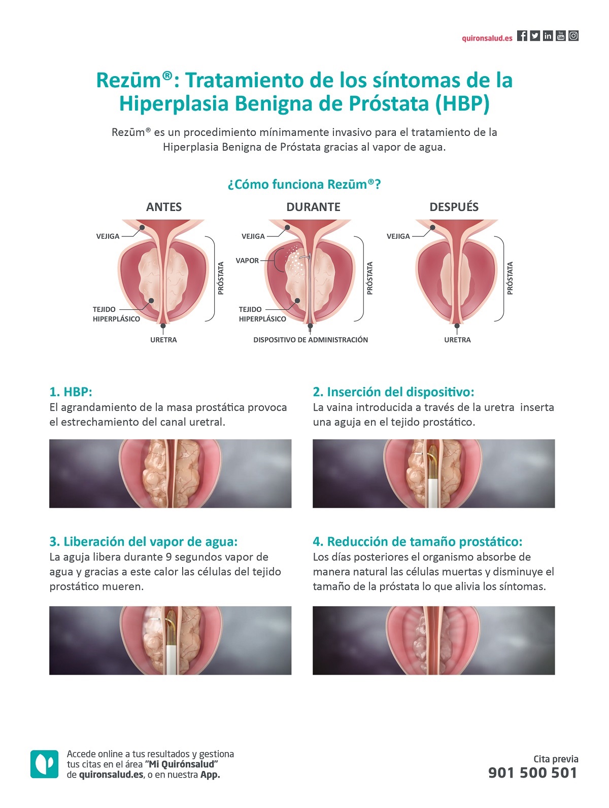 rezum valencia hiperplasia benigna de prostata